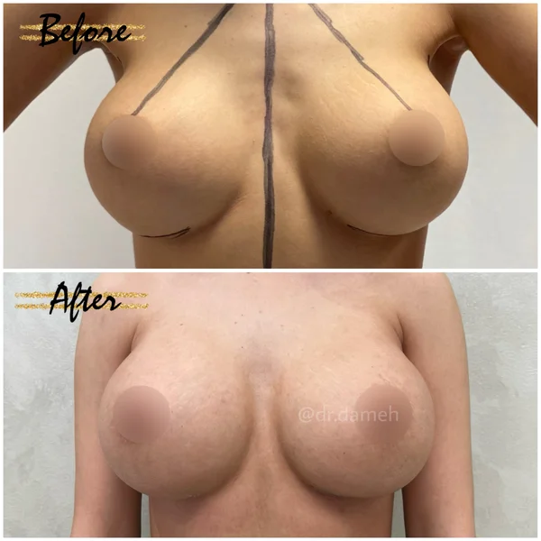 Schimbare / Revizie Implant - Rezultat 1