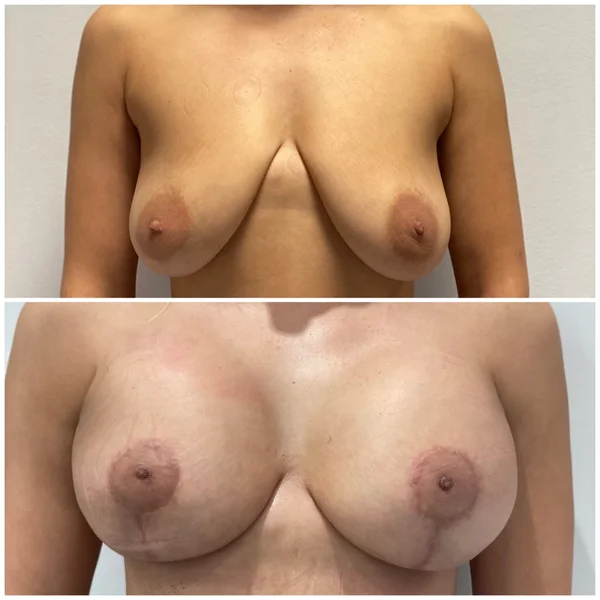 Mastopexie cu Implant - Rezultat 1