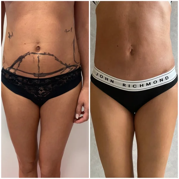 Abdominoplastie - Rezultat 1