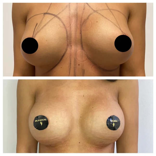 Augmentare Mamară - Implant - Rezultat 6