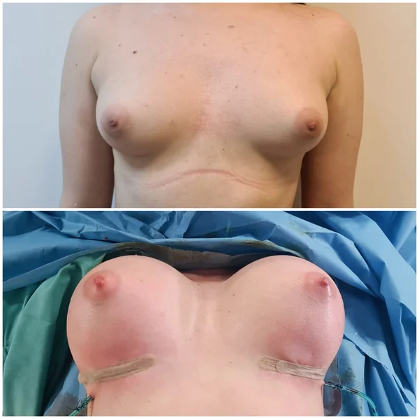 Augmentare Mamară - Implant - Rezultat 10