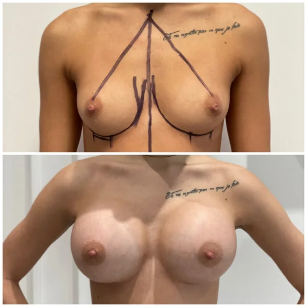 Augmentare Mamară - Implant - Rezultat 9