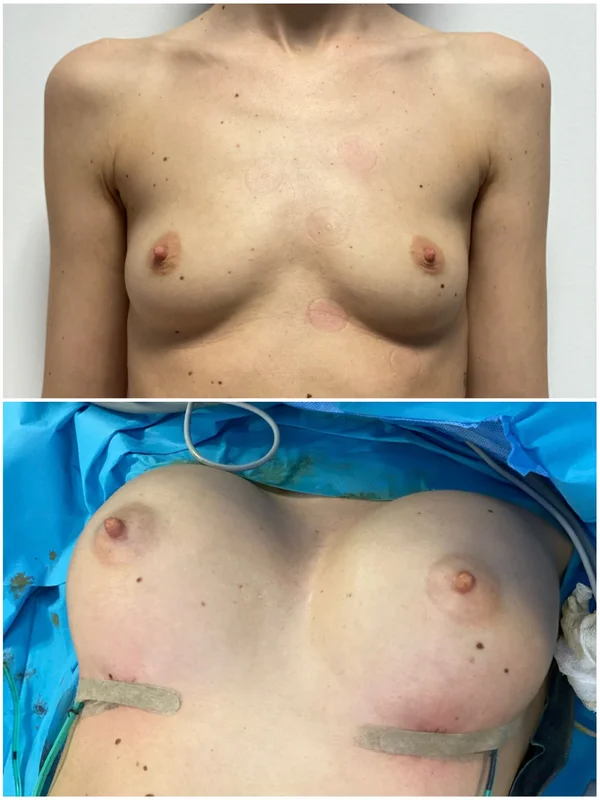 Augmentare Mamară - Implant - Rezultat 5