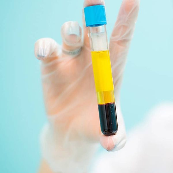 prp-therapy-1