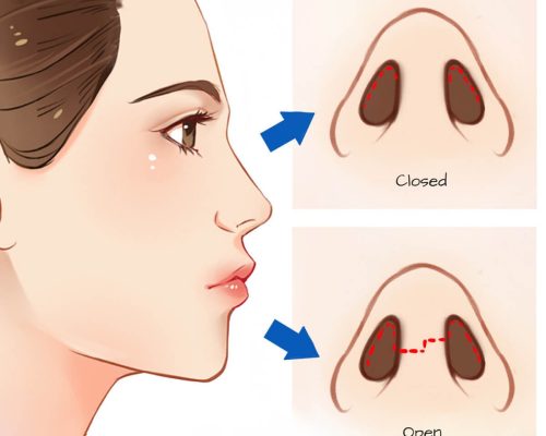 rhinoplastie